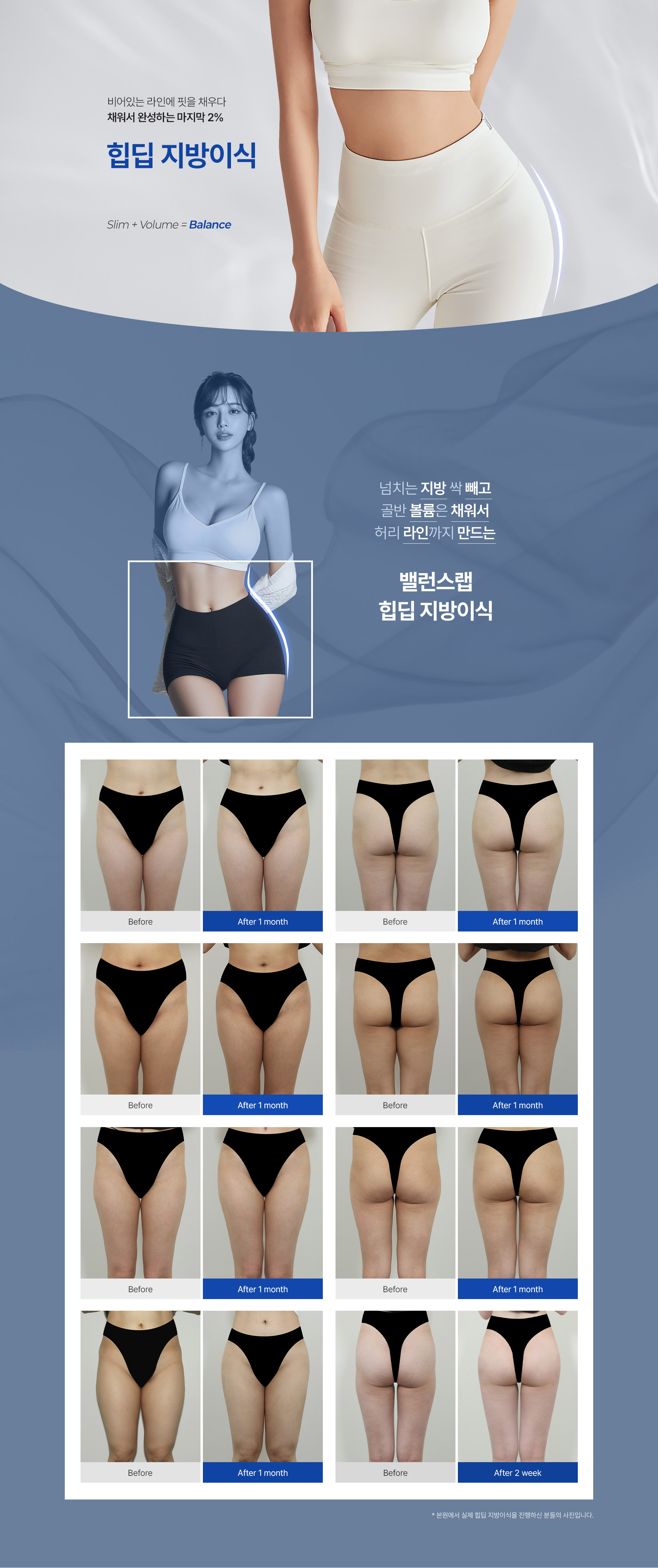 비어있는 힙 라인에 핏을 채우다 
[힙딥 지방이식]

▶ 복부, 허벅지에 넘치는 지방 빼서 골반 볼륨 채우는 힙딥 지방이식 
▶ 자가지방 이식으로 골반-힙라인을 자연스럽고 볼륨 있게! 
▶ 꺼진 힙딥을 보충해 하체 시작점을 시각적으로 올려 다리가 길어보이는 효과
▶ 고비율 순수지방 추출, PRP 자가혈 주입으로 높은 생착률 
▶ 아웃핏으로 검증된 체형 전담 의료진의 노하우로 만족스러운 결과 도출
