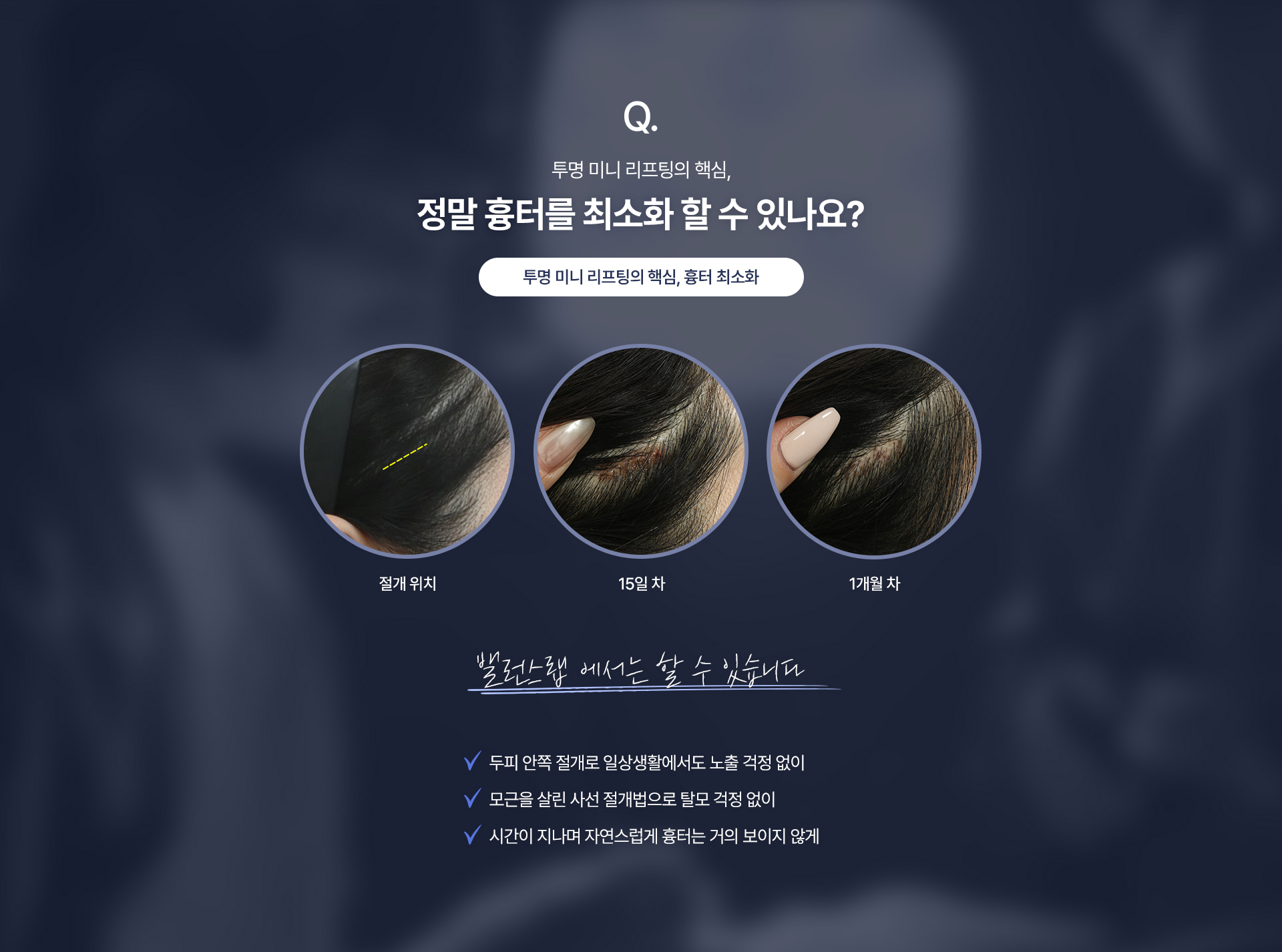 Q. 투명 미니 리프팅의 핵심
정말 흉터를 최소화 할 수 있나요?
[투명 미니 리프팅의 핵심, 흉터 최소화]
밸런스랩 에서는 할 수 있습니다
√두피 안쪽 절개로 일상생활에서도 노출 걱정 없이
√모근을 살린 사선 절개법으로 탈모 걱정 없이
√시간이 지나며 자연스럽게 흉터는 거의 보이지 않게

