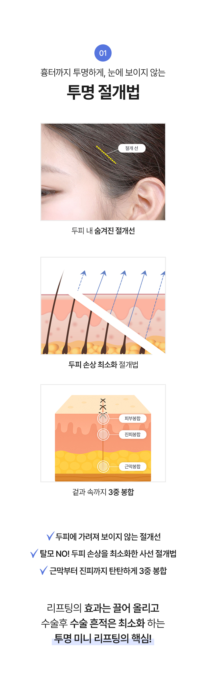 1. 흉터까지 투명하게, 눈에 보이지 않는
투명 절개법
두피 내 숨겨진 절개선, 두피 손상 최소화 절개법, 겉과 속까지 3중 봉합
√두피에 가려져 보이지 않는 절개선
√탈모 NO! 두피 손상을 최소화한 사선 절개법
√근막부터 진피까지 탄탄하게 3중 봉합
리프팅의 효과는 끌어 올리고 수술후 수술 흔적은 최소화 하는 투명 미니 리프팅의 핵심!



