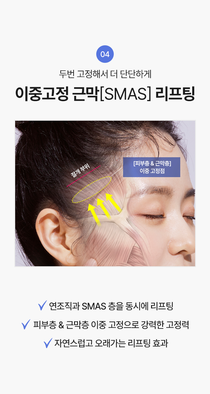 4. 두번 고정해서 더 단단하게
이중고정 근막[SMAS] 리프팅
√ 연조직과 SMAS 층을 동시에 리프팅
√ 피부층&근막층 이중 고정으로 강력한 고정력
√ 자연스럽고 오래가는 리프팅 효과


